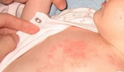 Çocuklarda isilik tehlikesine dikkat